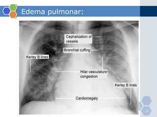 Edema pulmonar: 