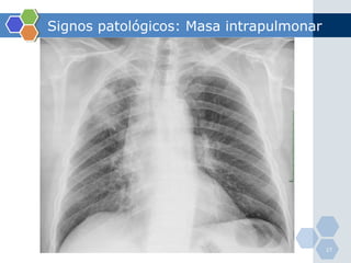 Signos patológicos: Masa intrapulmonar 