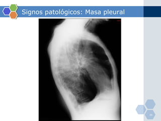 Signos patológicos: Masa pleural 