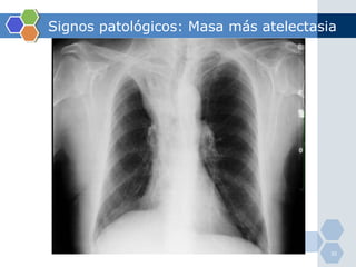 Signos patológicos: Masa más atelectasia 