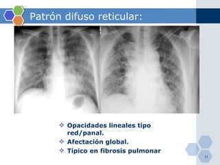 Patrón difuso reticular: Opacidades lineales tipo red/panal. Afectación global. Típico en fibrosis pulmonar 