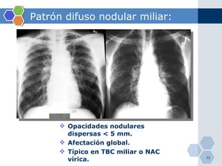 Patrón difuso nodular miliar: Opacidades nodulares dispersas < 5 mm. Afectación global. Típico en TBC miliar o NAC vírica. 