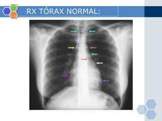 RX TÓRAX NORMAL:   