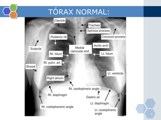 TÓRAX NORMAL: 