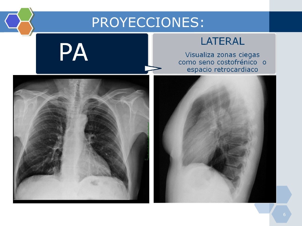 Rx Tórax Pa E Perfil