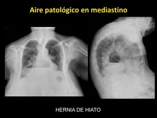 Aire patológico en mediastino




       HERNIA DE HIATO
 
