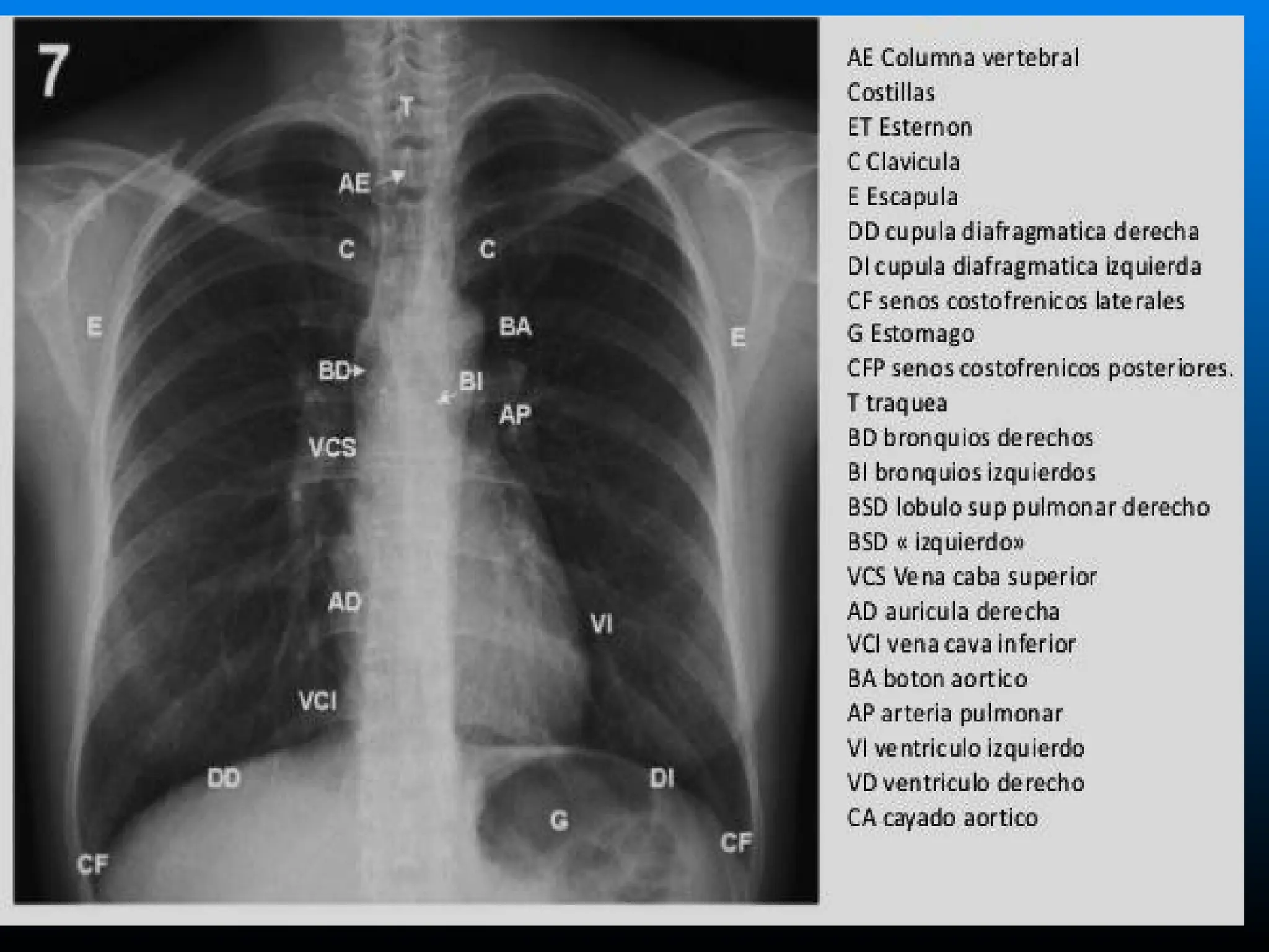 Torax Simple RADIOGRAFÍA NORMAL DE TÓRAX -- UNAN.pptx