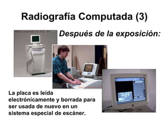 Radiografía Computada (3) Después de la exposición: La placa es leída electrónicamente y borrada para ser usada de nuevo en un sistema especial de escáner. 