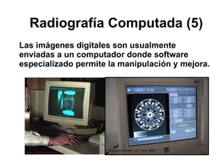 Radiografía Computada (5) Las imágenes digitales son usualmente enviadas a un computador donde software especializado permite la manipulación y mejora. 