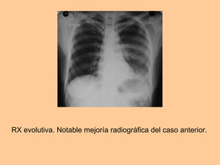 RX evolutiva. Notable mejoría radiográfica del caso anterior.  