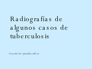 Sacado de cpicmha.sld.cu  Radiografías de algunos casos de tuberculosis 