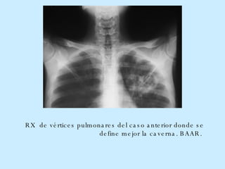 RX  de vértices pulmonares del caso anterior donde se define mejor la caverna. BAAR.  