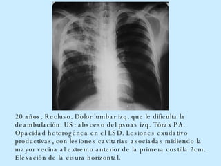20 años. Recluso. Dolor lumbar izq .  que le dificulta la deambulación.  US:  absceso del psoas izq. Tórax PA. Opacidad heterogénea en el LSD. Lesiones exudativo productivas, con lesiones cavitarias asociadas midiendo la mayor vecina al extremo anterior de la primera costilla 2cm. Elevación de la cisura horizontal.  