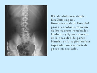 RX  de abdomen simple .   D ecúbito supino.  Borramiento de la línea del psoas, escoliosis, rotación de los cuerpos vertebrales lumbares y ligero aumento de la opacidad de partes blandas en la región lumbar izquierda con ausencia de gases en ese lado.  