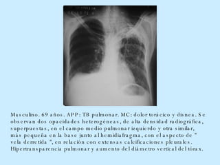 Masculino. 69 años. APP: TB pulmonar. MC: dolor torácico y disnea. Se observan dos opacidades heterogéneas, de alta densidad radiográfica, superpuestas, en el campo medio pulmonar izquierdo y otra similar, más pequeña en la base junto al hemidiafragma, con el aspecto de " vela derretida ", en relación con extensas calcificaciones pleurales. Hipertransparencia pulmonar y aumento del diámetro vertical del tórax.  