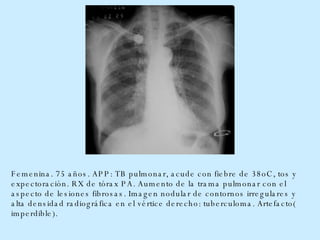 Femenina. 75 años. APP: TB pulmonar, acude con fiebre de 38oC, tos y expectoración. RX de tórax PA. Aumento de la trama pulmonar con el aspecto de lesiones fibrosas. Imagen nodular de contornos irregulares y alta densidad radiográfica en el vértice derecho: tuberculoma. Artefacto( imperdible).  