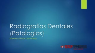 Radiografías Dentales
(Patologías)
MARIAN DÁVILA CERVANTES
 