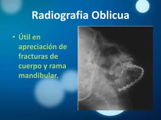 Radiografia Oblicua
• Útil en
  apreciación de
  fracturas de
  cuerpo y rama
  mandibular.
 