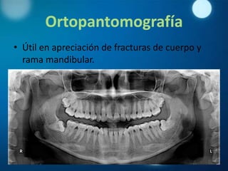 Ortopantomografía
• Útil en apreciación de fracturas de cuerpo y
  rama mandibular.
 