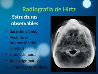 Radiografia de Hirtz
  Estructuras
  observables
• Base del cráneo
• Posición y
  orientación del
  cóndilos
• Seno esfenoidal
• Arcos cigomáticos
• Laminas pterigoideas
 