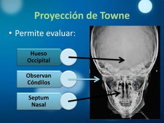 Proyección de Towne
• Permite evaluar:

     Hueso
    Occipital

    Observan
    Cóndilos

     Septum
      Nasal
 