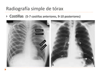 Radiografía simple de tórax
 Costillas (5-7 costillas anteriores, 9-10 posteriores)
 