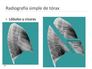 Radiografía simple de tórax
 Lóbulos y cisuras
.
 