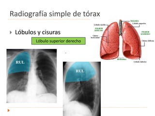Radiografía simple de tórax
 Lóbulos y cisuras
.
Lóbulo superior derecho
 
