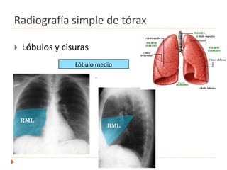 Radiografía simple de tórax
 Lóbulos y cisuras
.
Lóbulo medio
 
