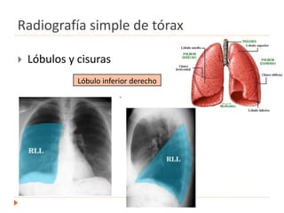 Radiografía simple de tórax
 Lóbulos y cisuras
.
Lóbulo inferior derecho
 