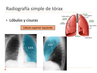 Radiografía simple de tórax
 Lóbulos y cisuras
.
Lóbulo superior izquierdo
 