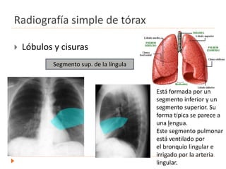Radiografía simple de tórax
 Lóbulos y cisuras
.
Segmento sup. de la língula
Está formada por un
segmento inferior y un
segmento superior. Su
forma típica se parece a
una lengua.
Este segmento pulmonar
está ventilado por
el bronquio lingular e
irrigado por la arteria
lingular.
 