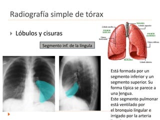 Radiografía simple de tórax
 Lóbulos y cisuras
.
Segmento inf. de la língula
Está formada por un
segmento inferior y un
segmento superior. Su
forma típica se parece a
una lengua.
Este segmento pulmonar
está ventilado por
el bronquio lingular e
irrigado por la arteria
 