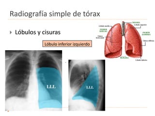 Radiografía simple de tórax
 Lóbulos y cisuras
.
Lóbulo inferior izquierdo
 