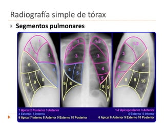  Segmentos pulmonares
.
Radiografía simple de tórax
 