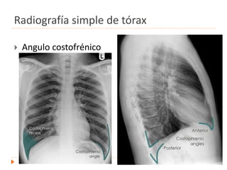Radiografía simple de tórax
 Angulo costofrénico
.
 