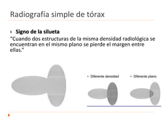 Radiografía simple de tórax
 Signo de la silueta
“Cuando dos estructuras de la misma densidad radiológica se
encuentran en el mismo plano se pierde el margen entre
ellas.”
.
 