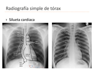 Radiografía simple de tórax
 Silueta cardiaca
.
 