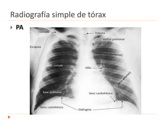 Radiografía simple de tórax
 PA
 