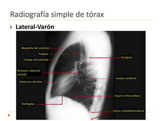 Radiografía simple de tórax
 Lateral-Varón
 