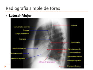 Radiografía simple de tórax
 Lateral-Mujer
 