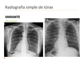 Radiografía simple de tórax
VARIANTE
.Situs inversus
 