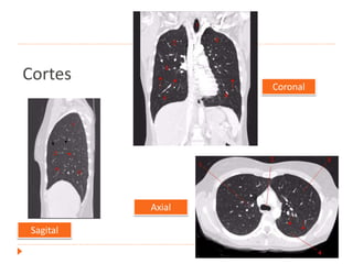Cortes
Coronal
Sagital
Axial
 