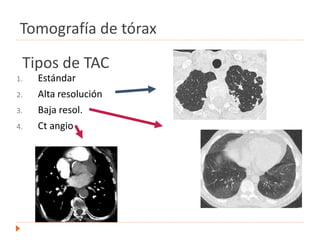 1. Estándar
2. Alta resolución
3. Baja resol.
4. Ct angio
Tipos de TAC
Tomografía de tórax
 