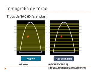 Tipos de TAC (Diferencias)
Alta definiciónRegular
Nódulos (ARQUITECTURA)
Fibrosis, Bronquiectasia,Enfisema
Tomografía de tórax
 