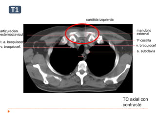 v. braquiocef.
T
E
a. subclavia
carótida izquierda
t. a. braquiocef.
v. braquiocef.
manubrio
esternal
1a costilla
articulación
esternoclavicular
TC axial con
contraste
T1
 