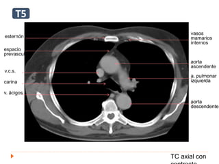TC axial con
esternón
v.c.s.
carina
v. ácigos
espacio
prevascular
aorta
ascendente
a. pulmonar
izquierda
aorta
descendente
vasos
mamarios
internos
T5
 