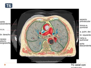aorta
ascendente
v.c.s.
br. derecho
receso
pleuro-
acigoesofágico
rama a.
pulmonar
tronco a.
pumonar
a. pulm. der.
br. izquierdo
aorta
descendente
espacio
prevascular
TC axial con
E
T6
 