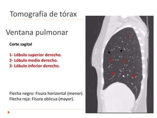 Ventana pulmonar
Corte sagital
1- Lóbulo superior derecho.
2- Lóbulo medio derecho.
3- Lóbulo inferior derecho.
Flecha negro: Fisura horizontal (menor).
Flecha roja: Fisura oblicua (mayor).
Tomografía de tórax
 