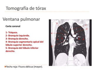 Ventana pulmonar
Corte coronal
1- Tráquea.
2- Bronquio izquierdo.
3- Bronquio derecho.
4- Bronquio segmentario apical del
lóbulo superior derecho.
5- Bronquio del lóbulo inferior
derecho.
Flecha roja: Fisura oblicua (mayor).
Tomografía de tórax
 